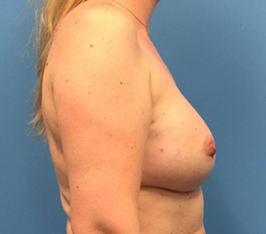 Case--138 | After Breast Reconstruction 2