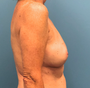 Case--13861 | After Breast Reconstruction 2