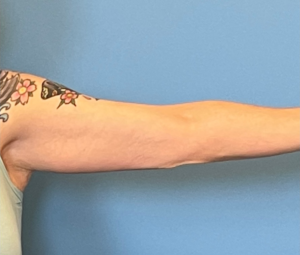 Brachioplasty-Arm-Lift-Case--18182 | After Arm Lift 2