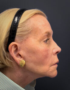 Facelift-Case--7247 | After Facelift 2