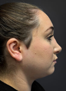 Submental-Liposuction-Case--3439 | After Submental Liposuction 2