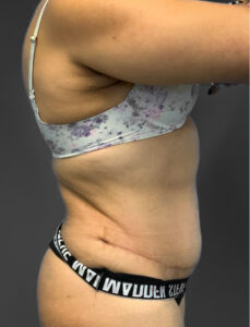 Abdominoplasty-Case--2637 | After Tummy Tuck 2