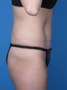 Tummy-Tuck-Case--250 | After Tummy Tuck 2
