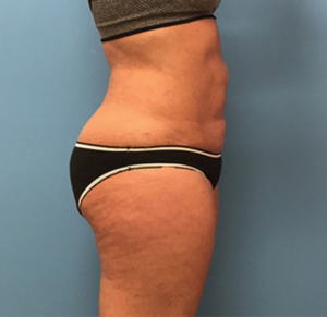 Liposuction-Case--72-1 | After Liposuction 2