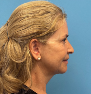 Facelift-Case--292 | After Facelift 2