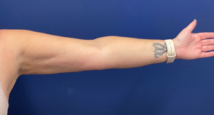 Case--399 | After Liposuction 2