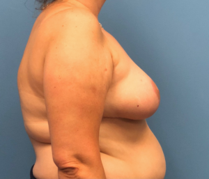 Breast-Reduction-Case--13597 | After Breast Reduction 2