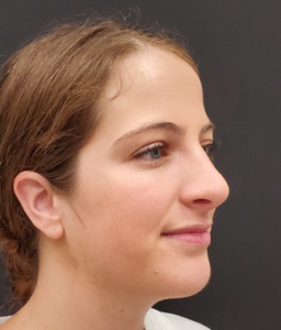 Rhinoplasty-Case--381 | After Rhinoplasty 2