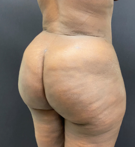 Brazilian-Butt-Lift-Case--353 | After Brazilian Butt Lift 2