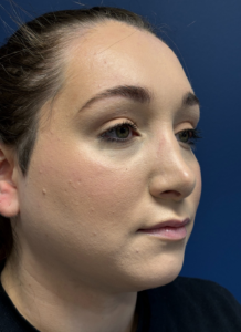 Submental-Liposuction-Case--29107 | After Submental Liposuction 2