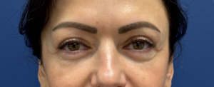 Lower-Blepharoplasty-Case--26939-1 | After Eyelid Surgery 2