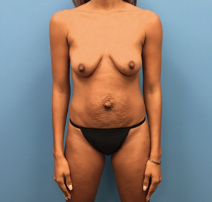 Mommy-Makeover-Case--262 | Before Mommy Makeover 1