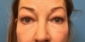 Blepharoplasty-Case--393 | Before Eyelid Surgery 1