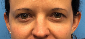 Blepharoplasty-Case--14261 | Before Eyelid Surgery 1
