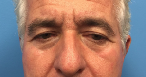 Blepharoplasty-Case--288 | Before Eyelid Surgery 1
