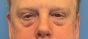 Blepharoplasty-Case--289 | Before Eyelid Surgery 1