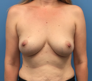 Breast-Reduction-Case--295 | Before Breast Reconstruction 1