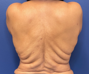 Body-Lift-Case--274 | Before Body Lift 1