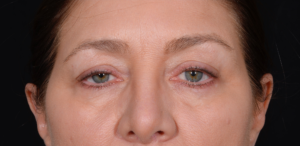 Blepharoplasty-Case--358 | Before Eyelid Surgery 2