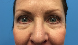 Lower-Blepharoplasty-Case--287 | Before Eyelid Surgery 1