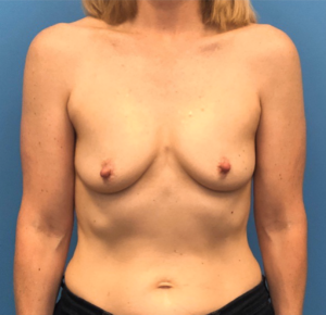 Case--301 | Before Breast Reconstruction 1