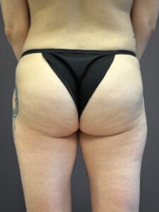 Aveli-Case--1431 | Before Dr. Frank Albino 1