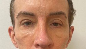 Blepharoplasty-Case--357 | Before Eyelid Surgery 2