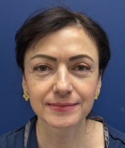 Lower-Blepharoplasty-Case--26939-1 | Before Eyelid Surgery 1
