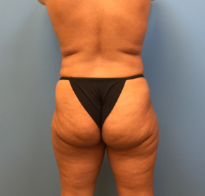 Case--247 | Before Liposuction 2