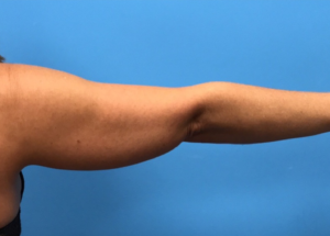 Case--280 | Before Liposuction 2