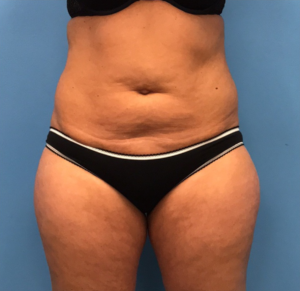 Liposuction-Case--72-1 | Before Liposuction 1