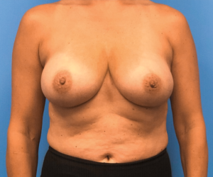 Breast-Reconstruction-Case--294 | Before Breast Reconstruction 1