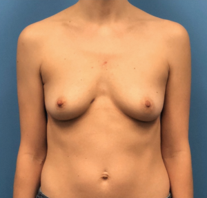 Breast-Reconstruction-Case--300 | Before Breast Reconstruction 1
