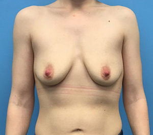 Case--93 | Before Breast Augmentation 1