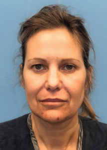 Facelift-Case--18078 | Before Facelift 1