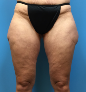 Case--281 | Before Liposuction 1