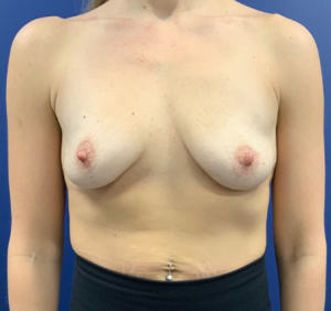 Breast-Augmentation-Case--20570 | Before Breast Augmentation 1