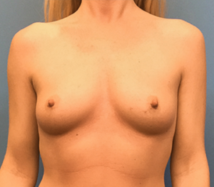Case--140 | Before Breast Reconstruction 1