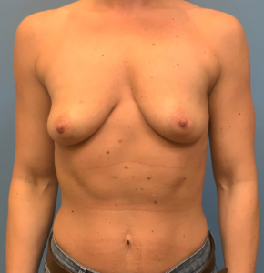 Case--17251 | Before Breast Augmentation 1