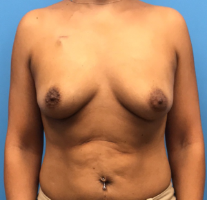 Case--11132 | Before Breast Reconstruction 1