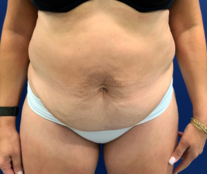 Tummy-Tuck-Case--21804 | Before Tummy Tuck 1