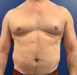 Gynecomastia-Case--20376 | Before Gynecomastia / Male Breast Reduction 1
