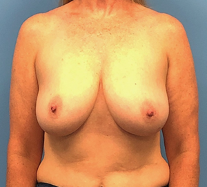 Case--21024 | Before Breast Reconstruction 1