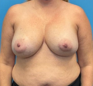 Breast-Reconstruction-Case--25682 | Before Breast Reconstruction 1