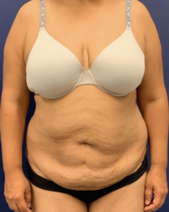 Liposuction-Tummy-Tuck-Case--25576 | Before Liposuction 1