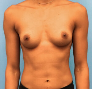 Breast-Augmentation-Case--221 | Before Breast Augmentation 1