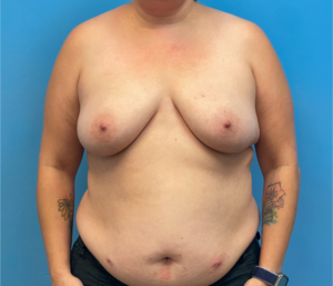 DIEP-Flap-Case--28021 | Before DIEP Flap 1