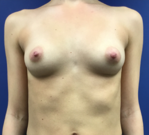 Breast-Augmentation-Case--19360 | Before Breast Augmentation 1