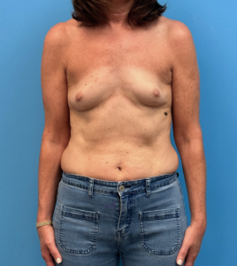 Breast-Reconstruction-Case--28688 | Before Breast Reconstruction 1