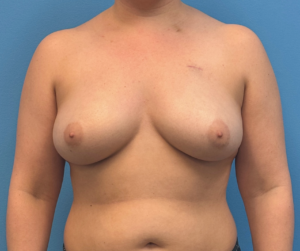 Breast-Reconstruction-Case--28689 | Before Breast Reconstruction 1